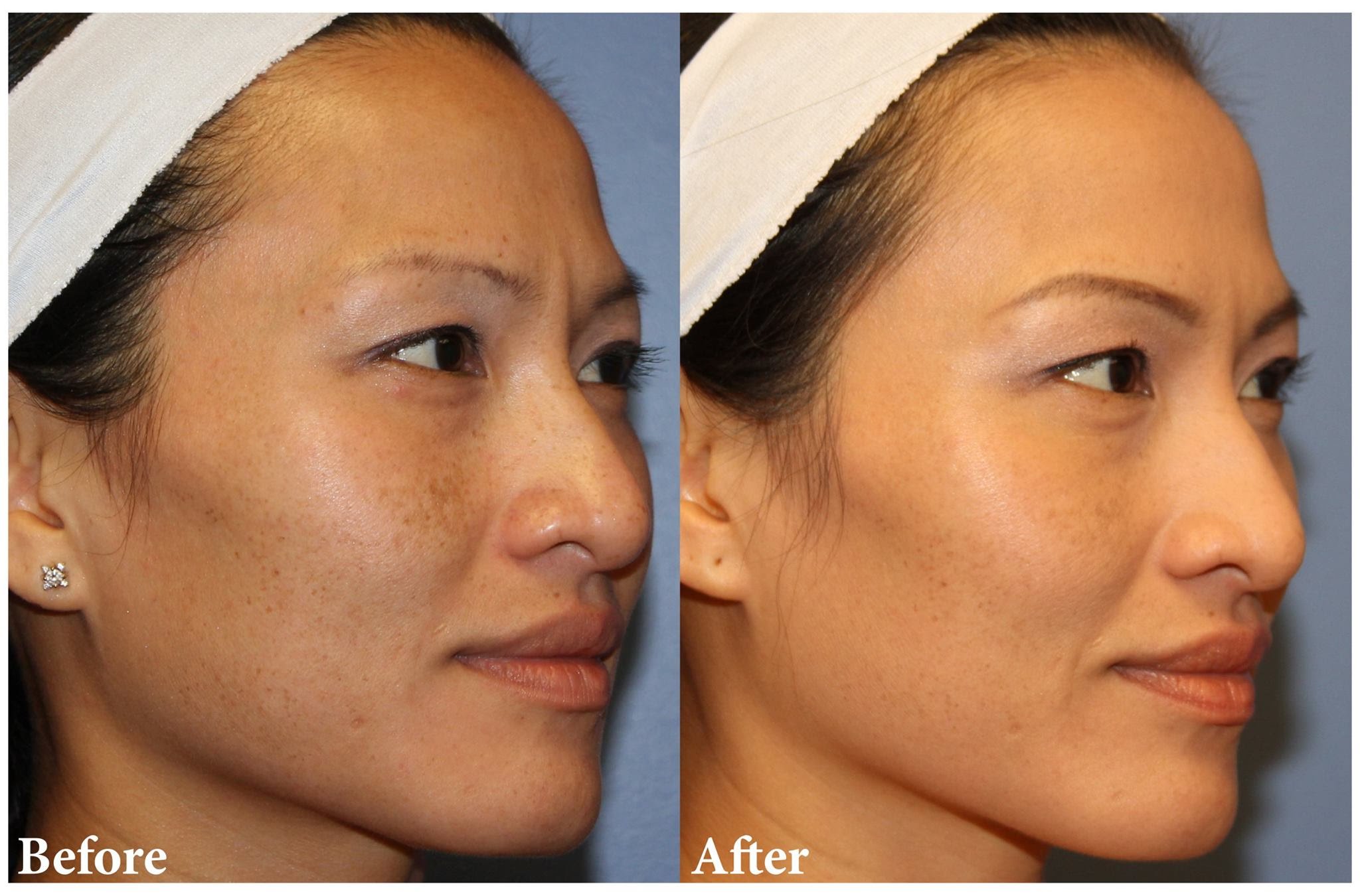 Results from Clear &amp; Brilliant Permea Laser - Laser Center ...